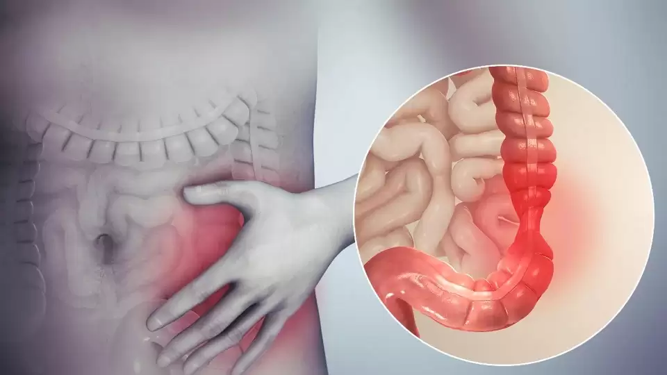  اليك 5 مشروبات طبيعية لعلاج  ألم القولون العصبي بكل سهولة اذا كنت تعاني منها !