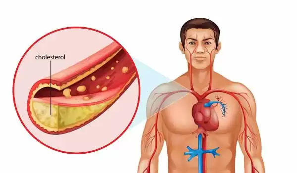 4 أطعمة تُخفض الكوليسترول المسبب لأمراض القلب والسكتة الدماغية والوفاة المبكرة ؟